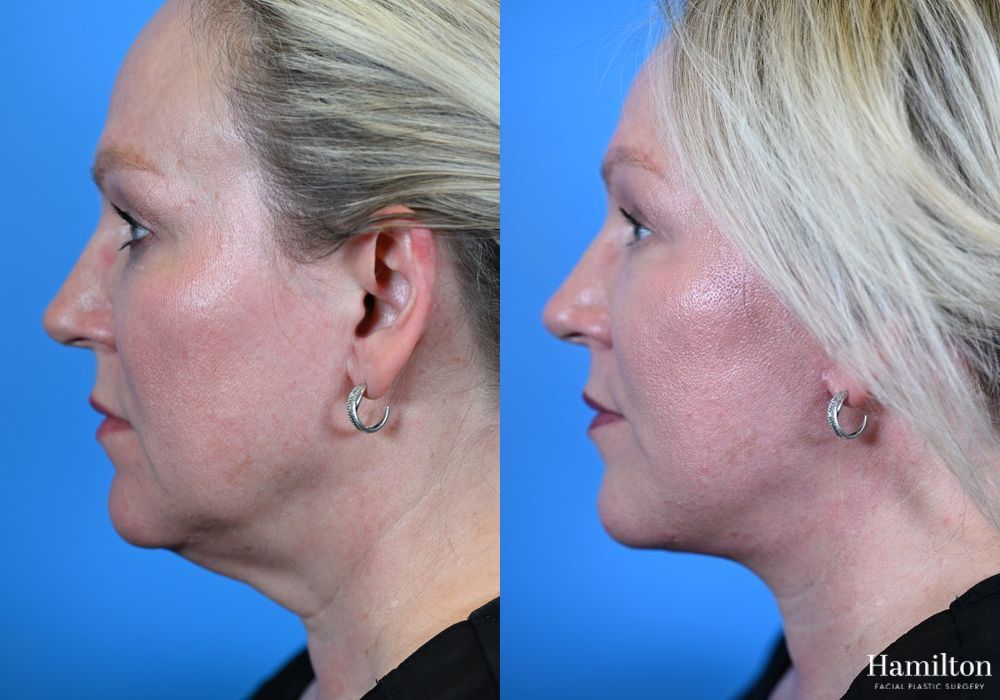 Before and after Facelift case 37317