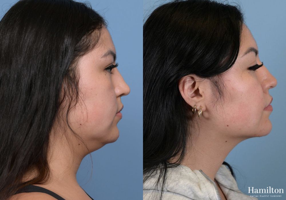 Before and after Submentoplasty/Deep Neck Lift case 37132 - Angle 3
