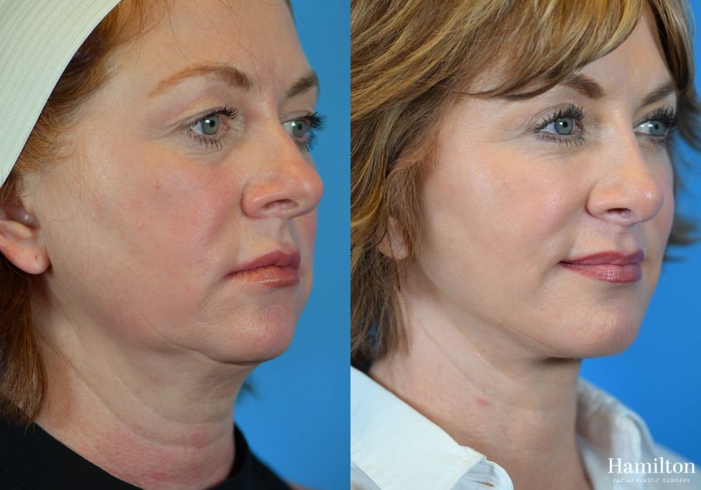Before and after Neck Rejuvenation case 37168 - Angle 3