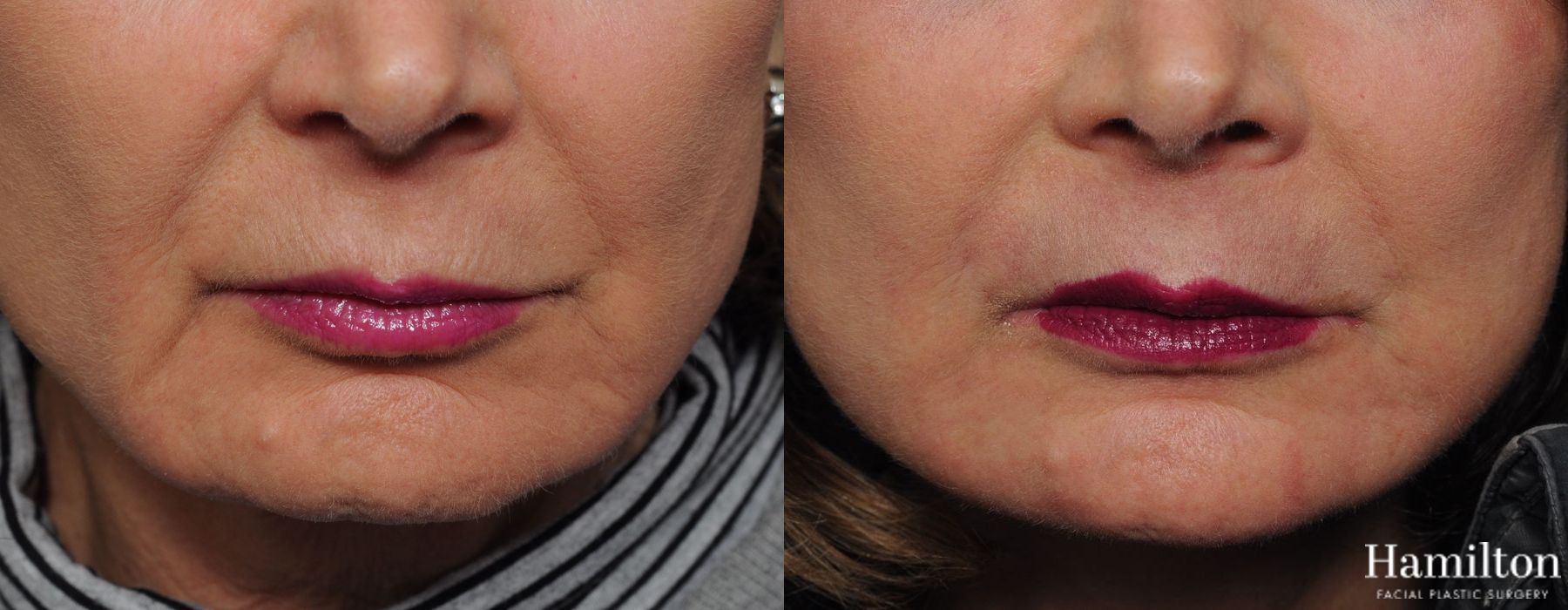 Before and after Laser - Sciton case 37125