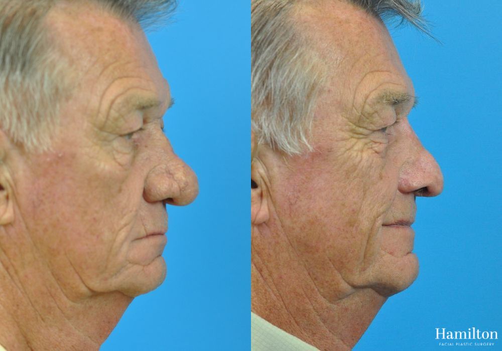 Before and after Rhinophyma case 37351 - Angle 2