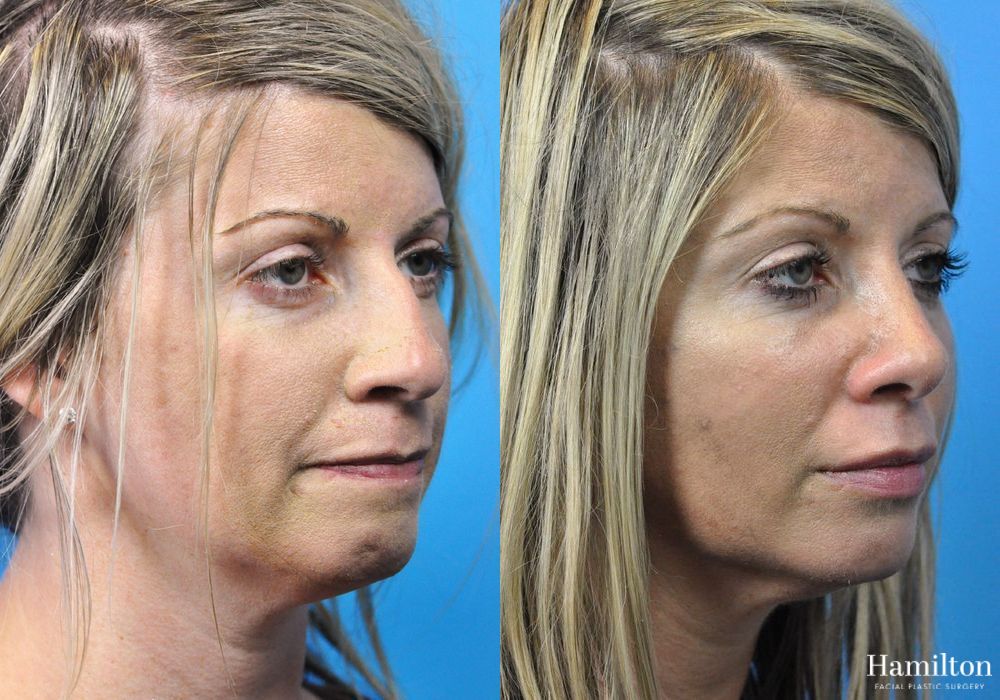 Before and after Rhinoplasty case 37334 - Angle 3