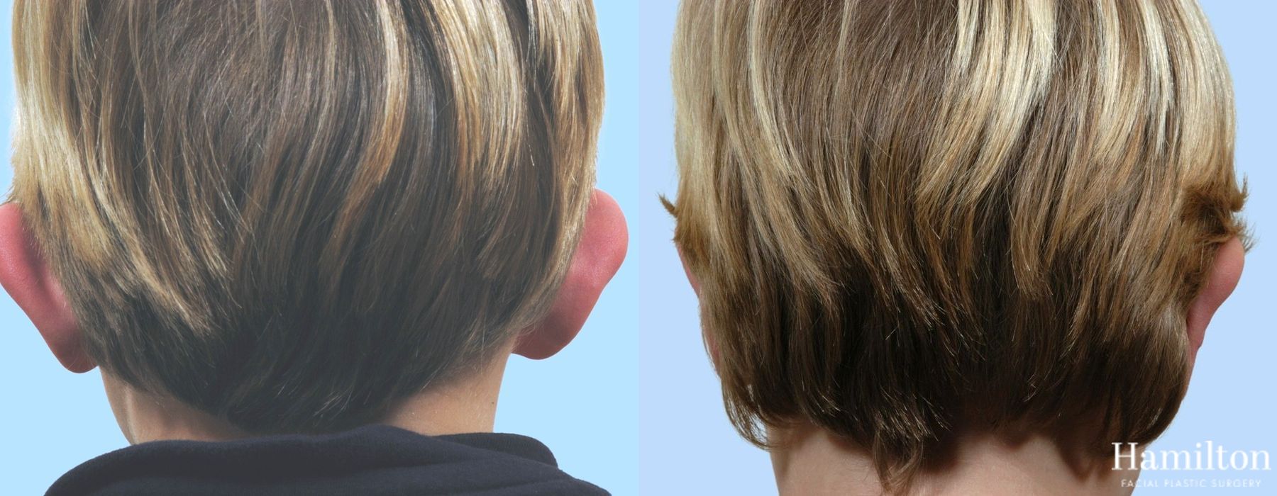 Before and after Otoplasty case 37105 - Angle 2