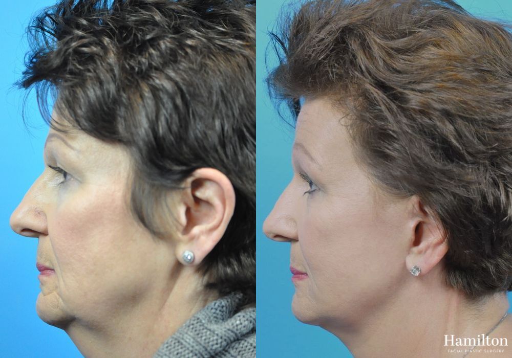 Before and after Facelift case 37325
