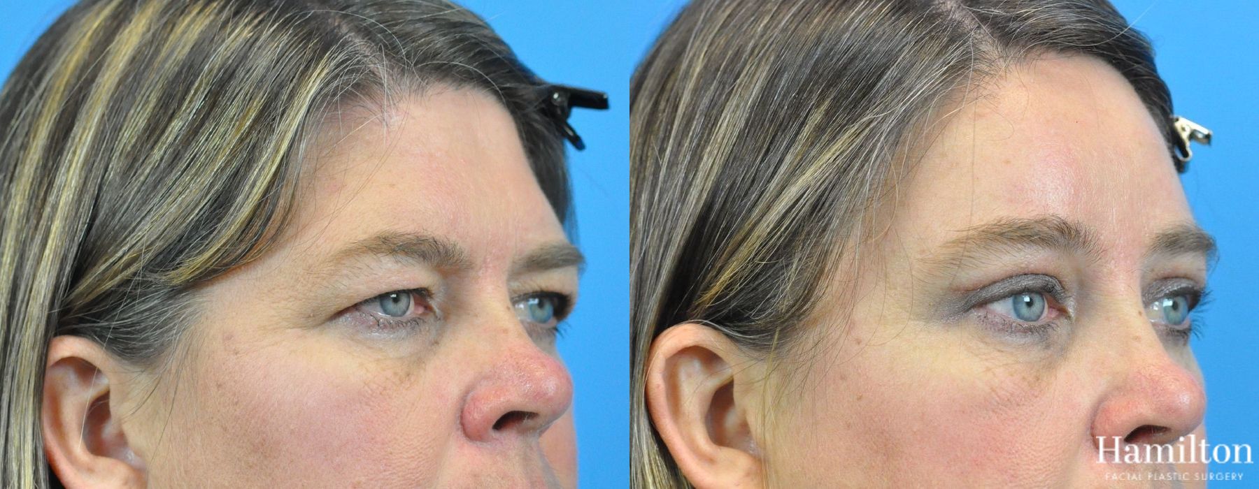Before and after Brow Lift case 37209 - Angle 3