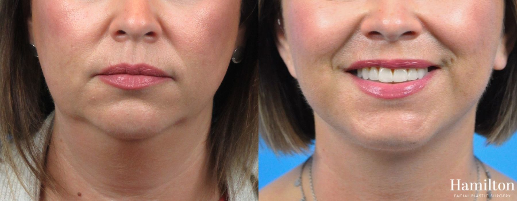 Before and after Neck Rejuvenation case 37246 - Angle 2