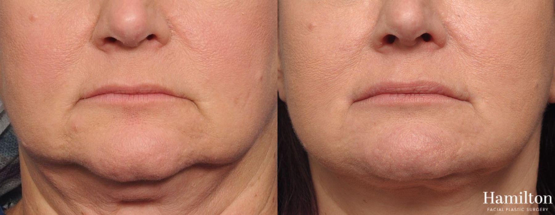 Before and after Lip Lift case 37165