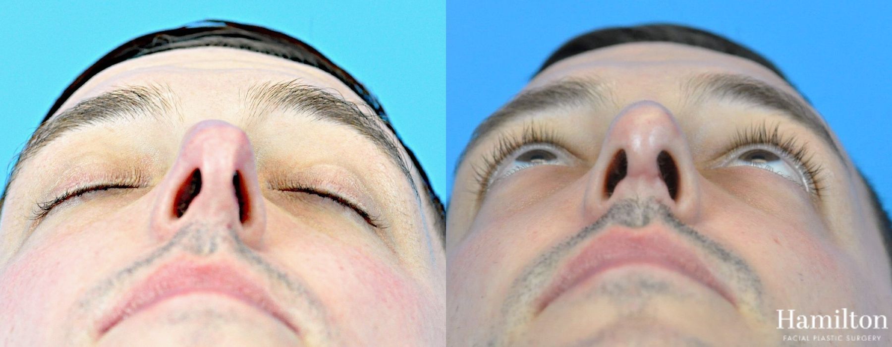 Before and after Rhinoplasty case 37333 - Angle 2