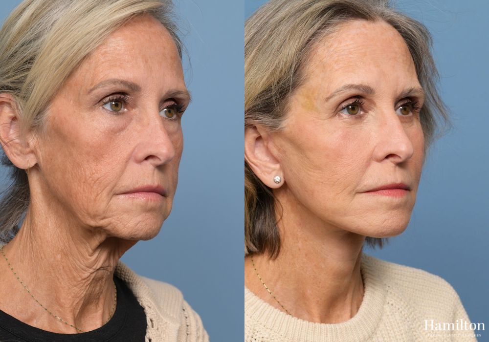 Before and after Fat Grafting case 37098 - Angle 2