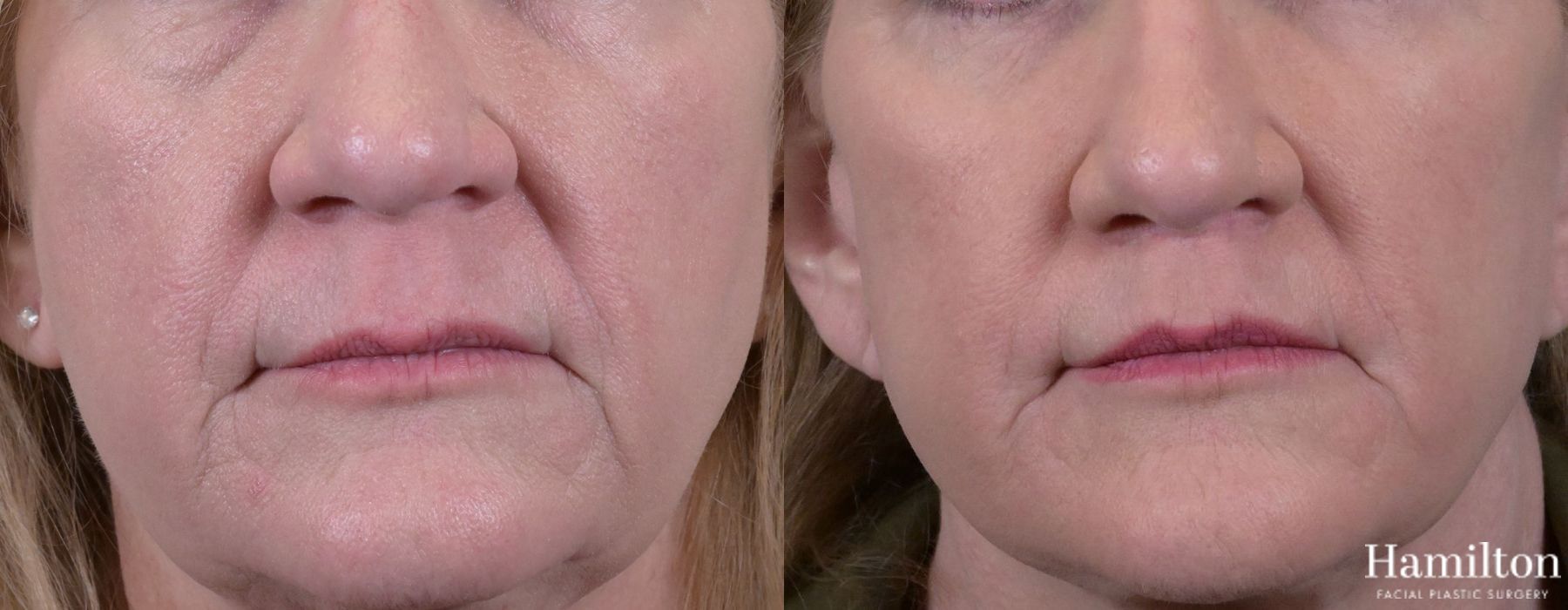 Before and after Lip Lift case 37144