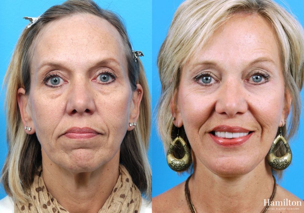 Before and after Facelift case 37286