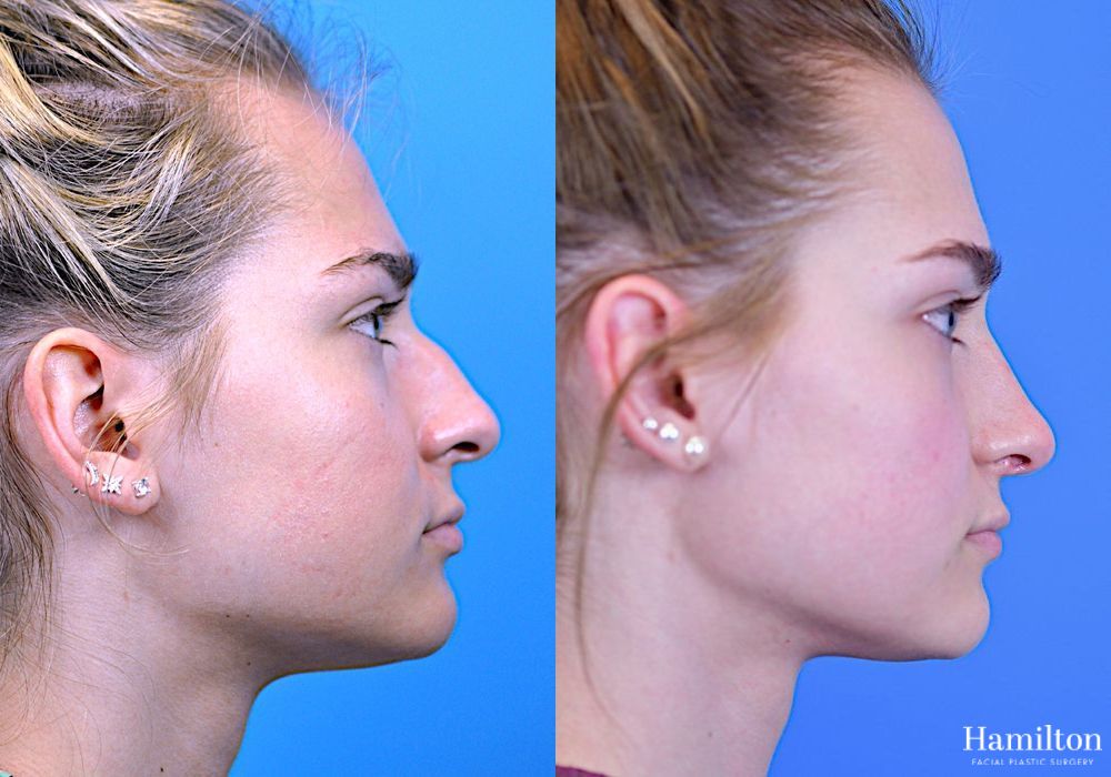Before and after Rhinoplasty case 37251