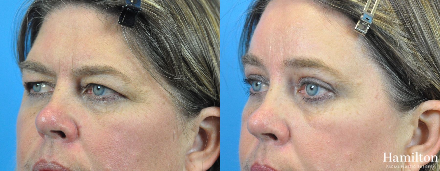 Before and after Blepharoplasty case 37272 - Angle 3