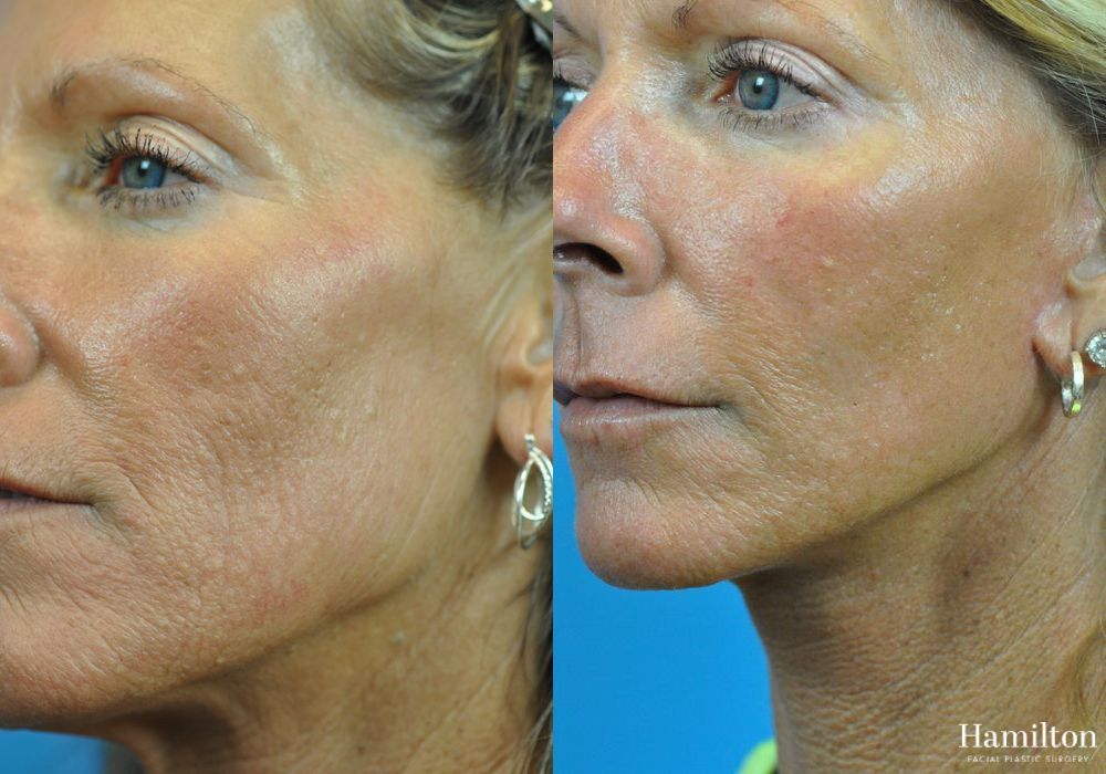 Before and after Laser - Fractional Resurfacing case 37353 - Angle 2