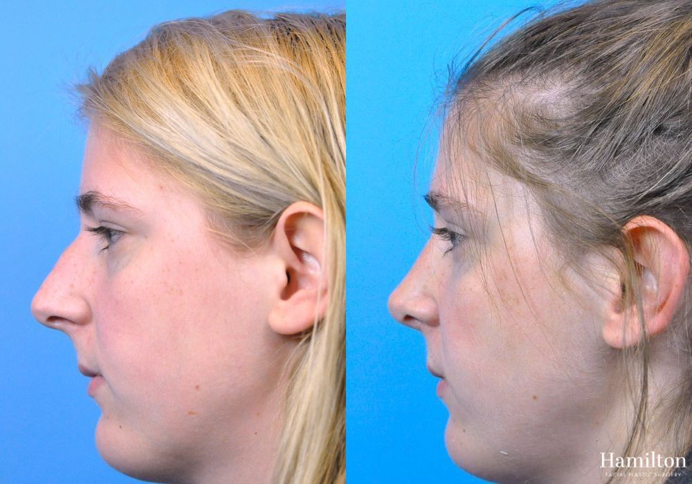 Before and after Rhinoplasty case 37354 - Angle 4