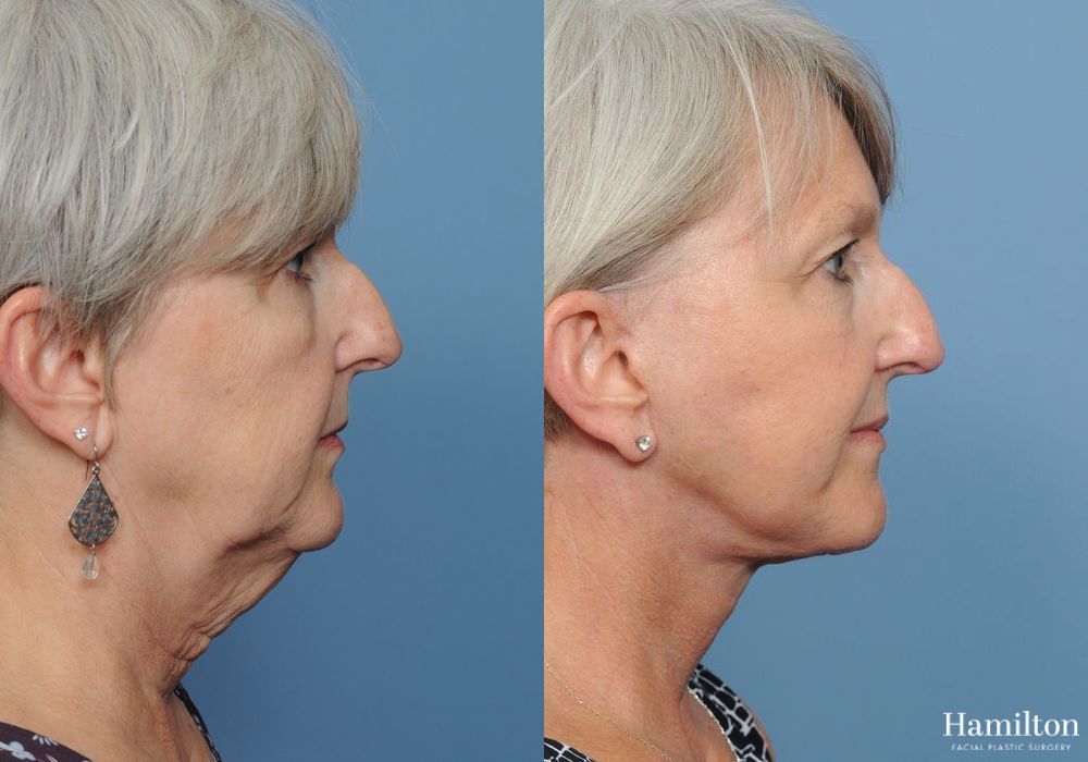 Before and after Neck Rejuvenation case 37127