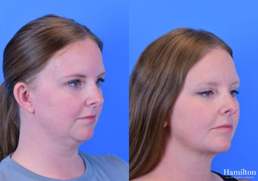 Before and after FaceTite case 37108 - Angle 4