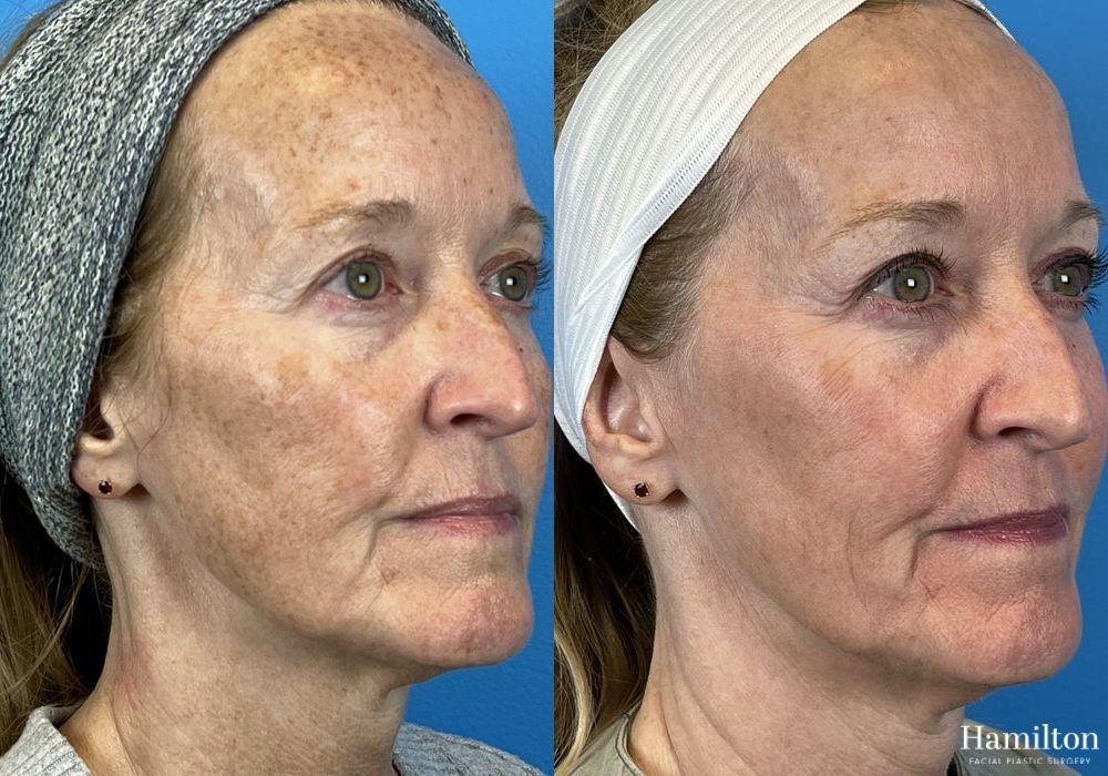 Before and after Laser - Broad Band Light (BBL) case 37099 - Angle 5