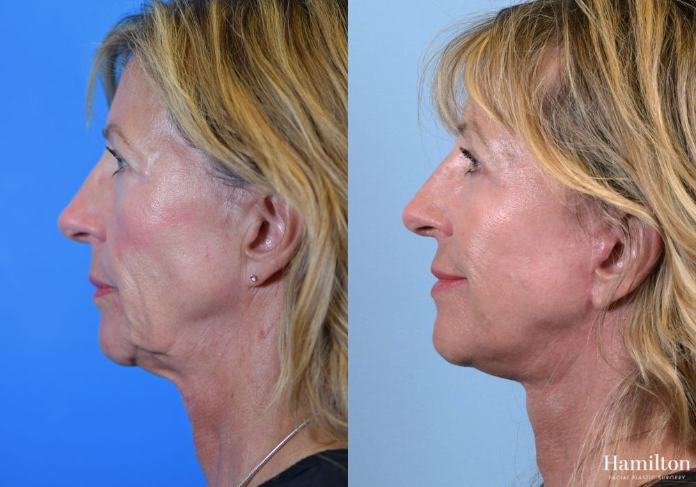 Before and after Facelift case 37279 - Angle 4
