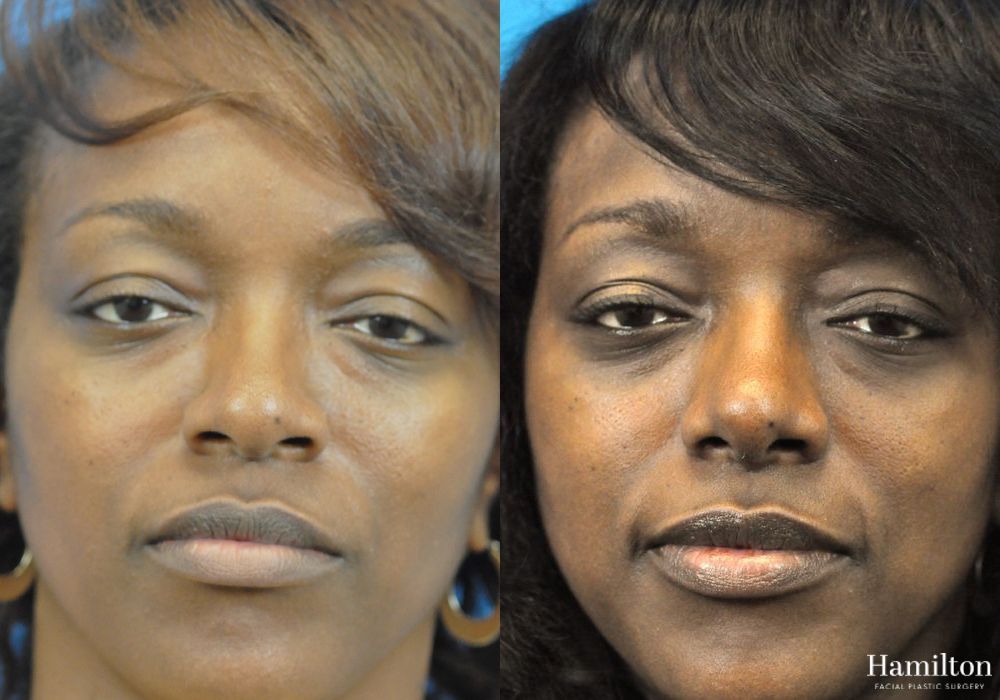Before and after Rhinoplasty case 37295 - Angle 3