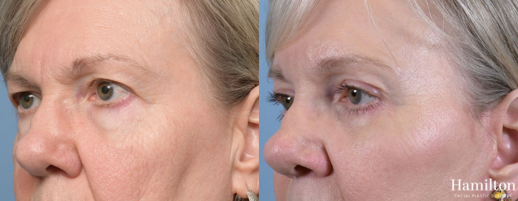 Before and after Blepharoplasty case 37195 - Angle 5