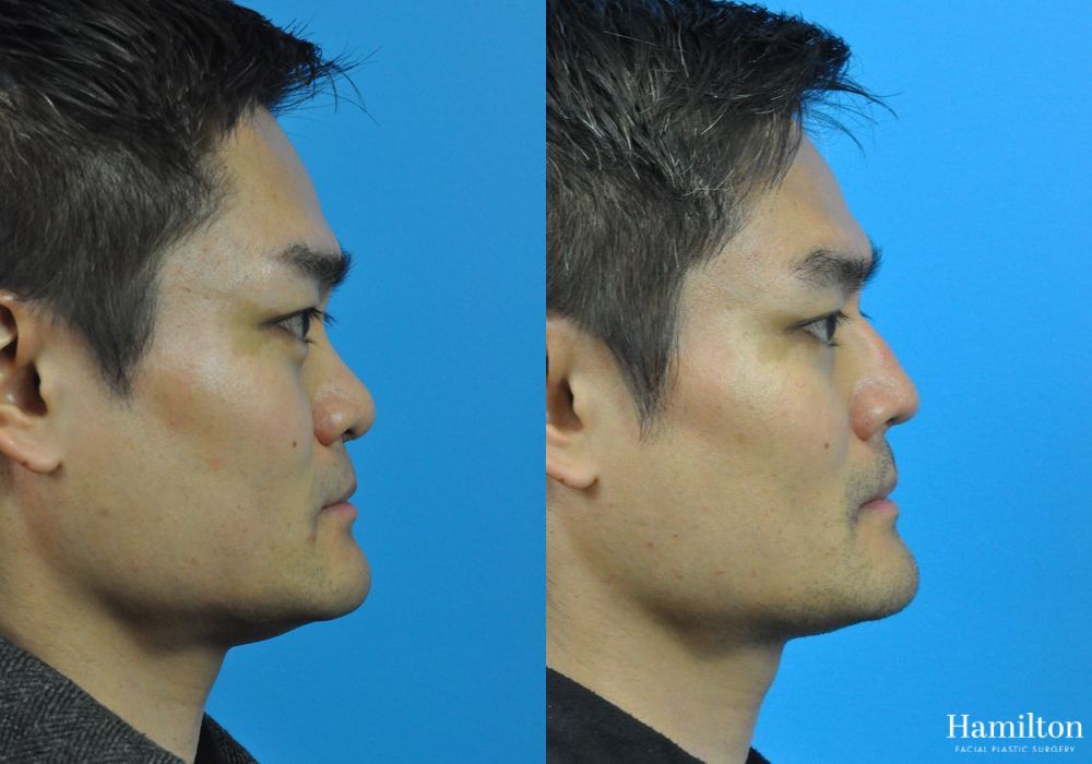 Before and after Rhinoplasty case 37288