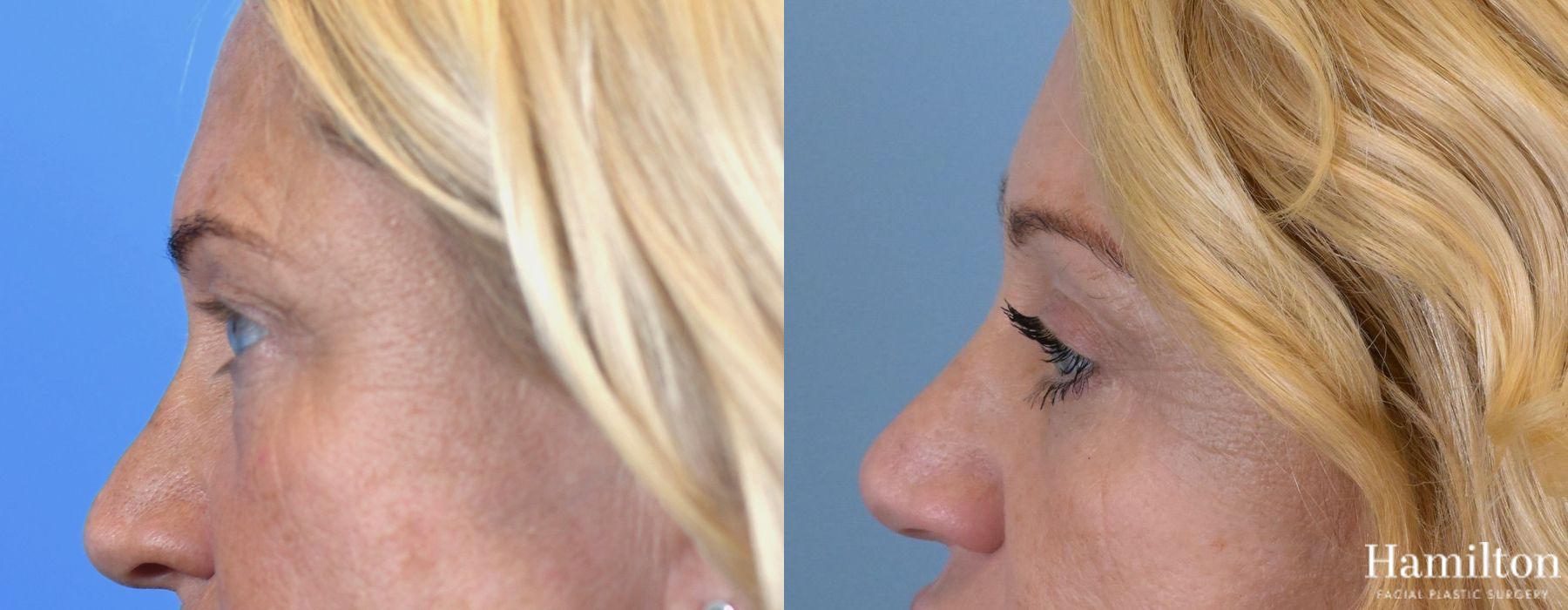Before and after Blepharoplasty case 37289 - Angle 2