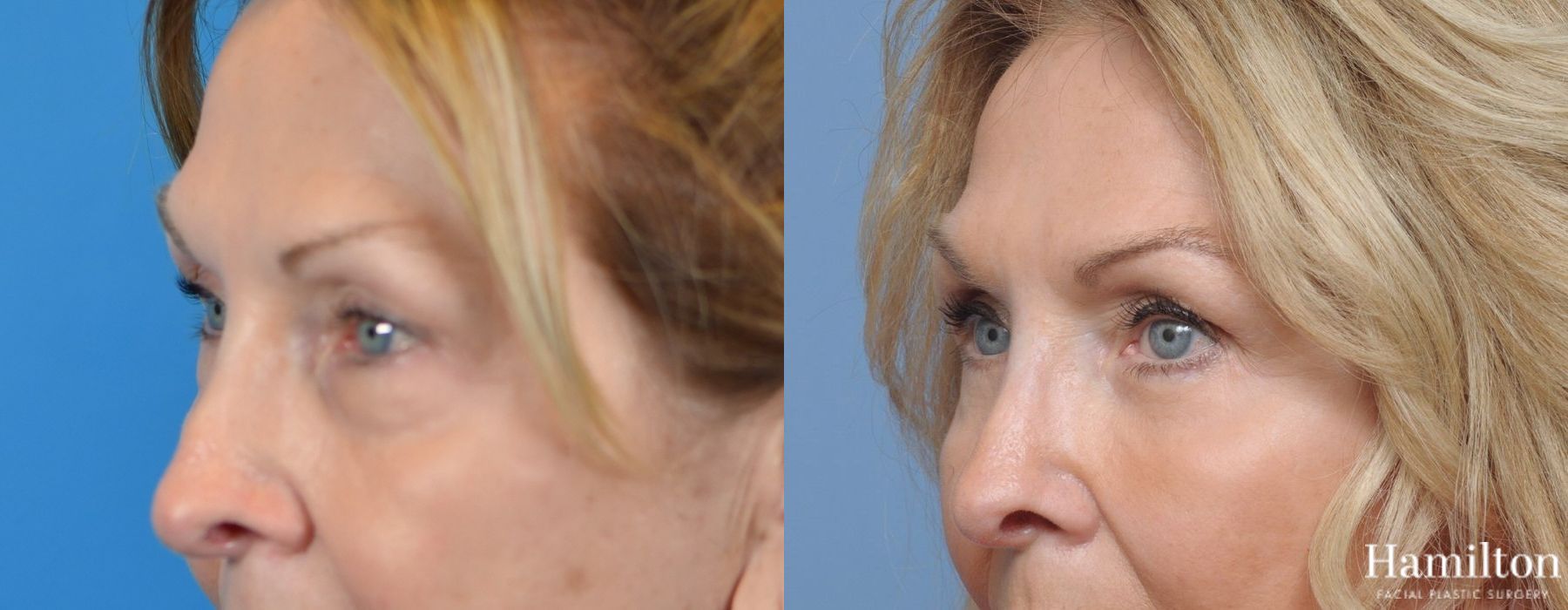 Before and after Blepharoplasty case 37129 - Angle 4