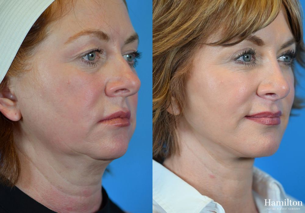 Before and after Rhinoplasty case 37318 - Angle 2