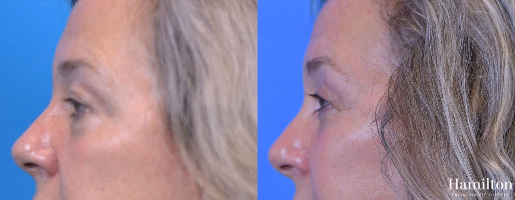 Before and after Blepharoplasty case 37310 - Angle 5