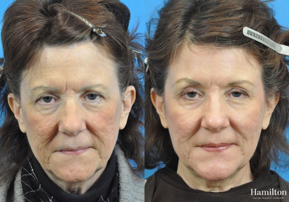 Before and after Laser - CO2 case 37249 - Angle 2