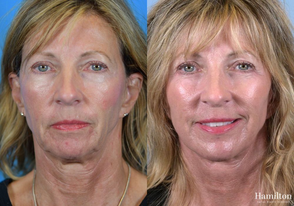 Before and after Facelift case 37279 - Angle 5