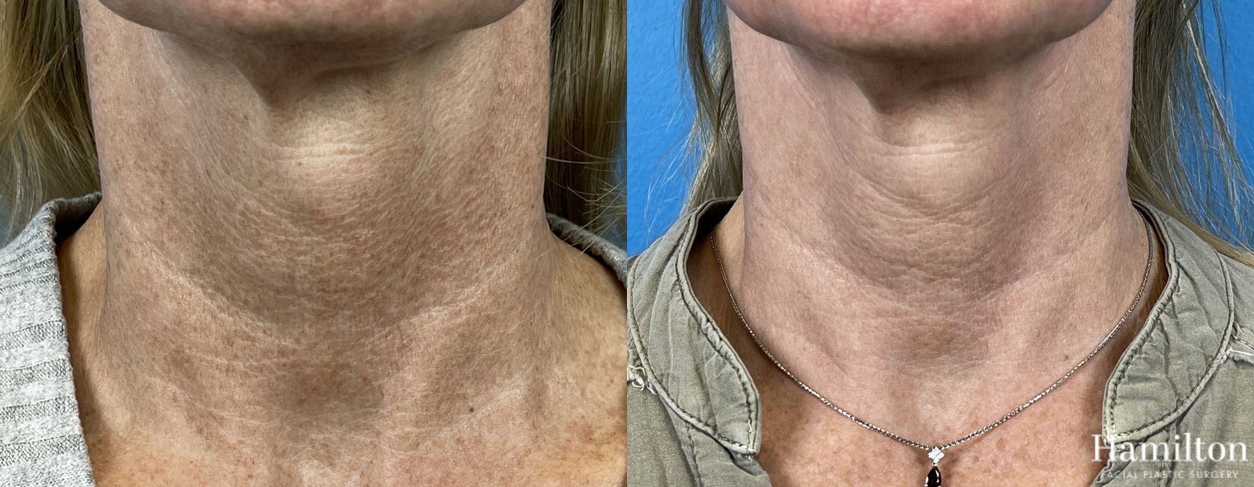 Before and after Laser - HALO case 37364 - Angle 6