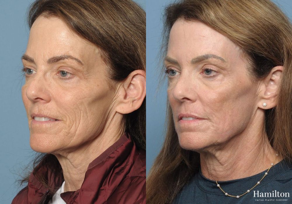 Before and after Laser - CO2 case 37150 - Angle 2