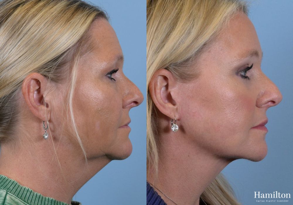 Before and after Brow Lift case 37178 - Angle 3