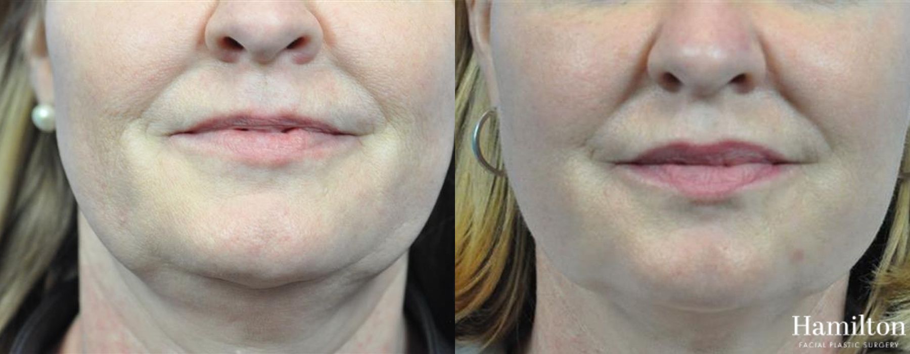 Before and after FaceTite case 37148