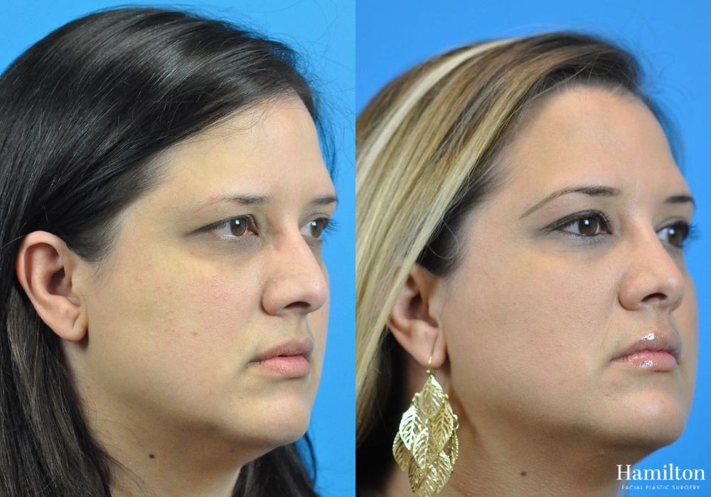 Before and after Rhinoplasty case 37327