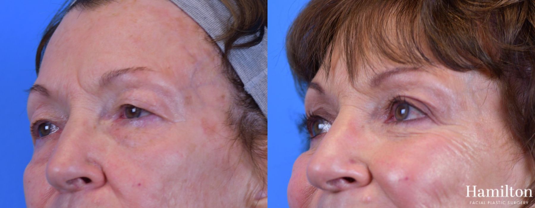 Before and after Blepharoplasty case 37297 - Angle 4