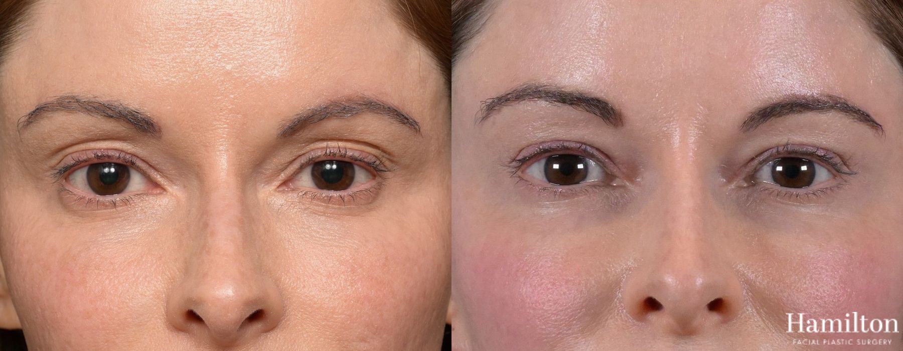 Before and after Blepharoplasty case 37169 - Angle 4