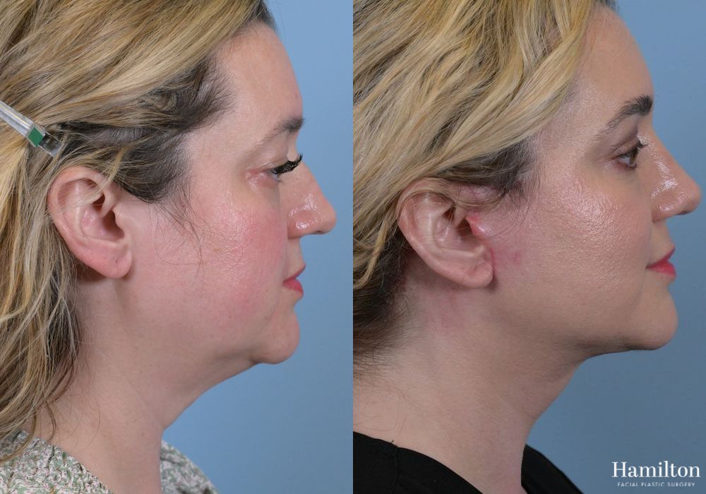Before and after Rhinoplasty case 37276 - Angle 2
