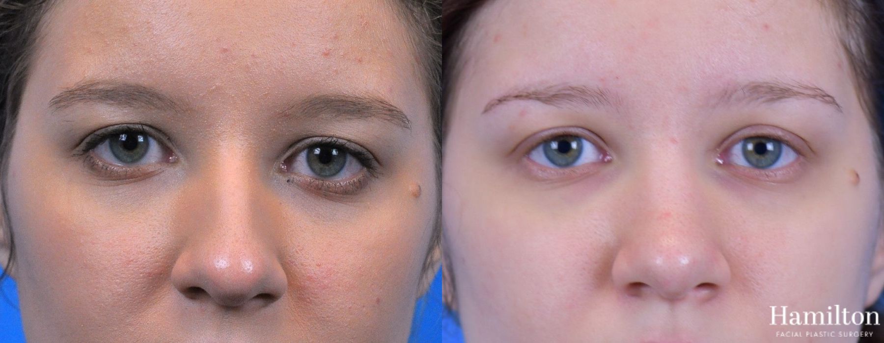 Before and after Rhinoplasty case 37269 - Angle 5