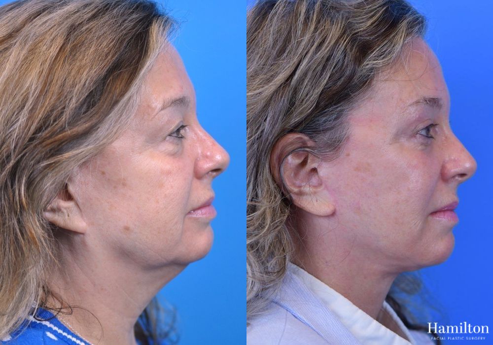 Before and after Facelift case 37294