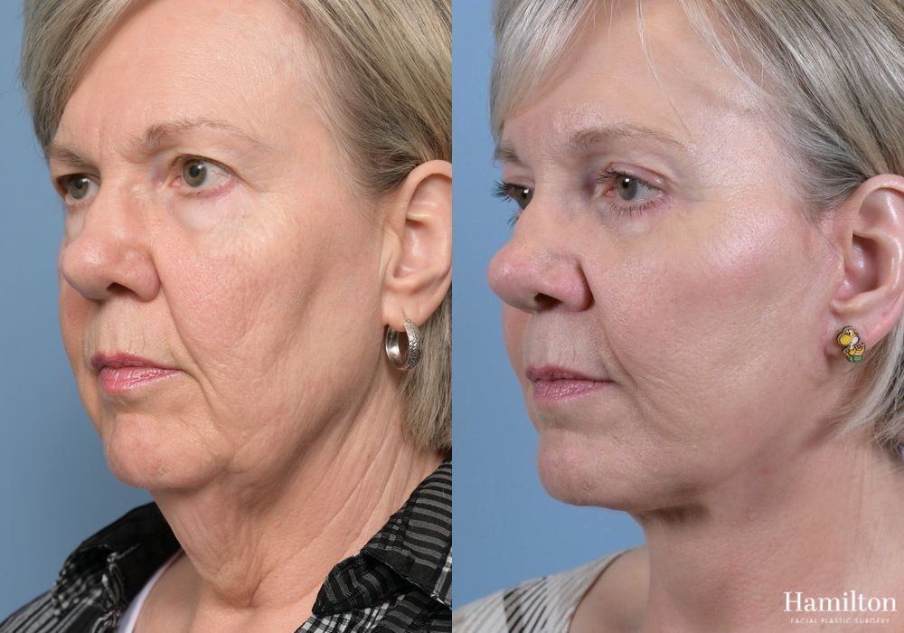 Before and after Neck Rejuvenation case 37113 - Angle 4