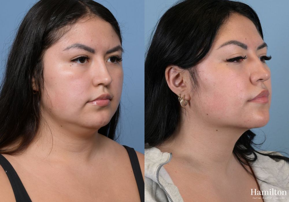 Before and after Submentoplasty/Deep Neck Lift case 37132 - Angle 2