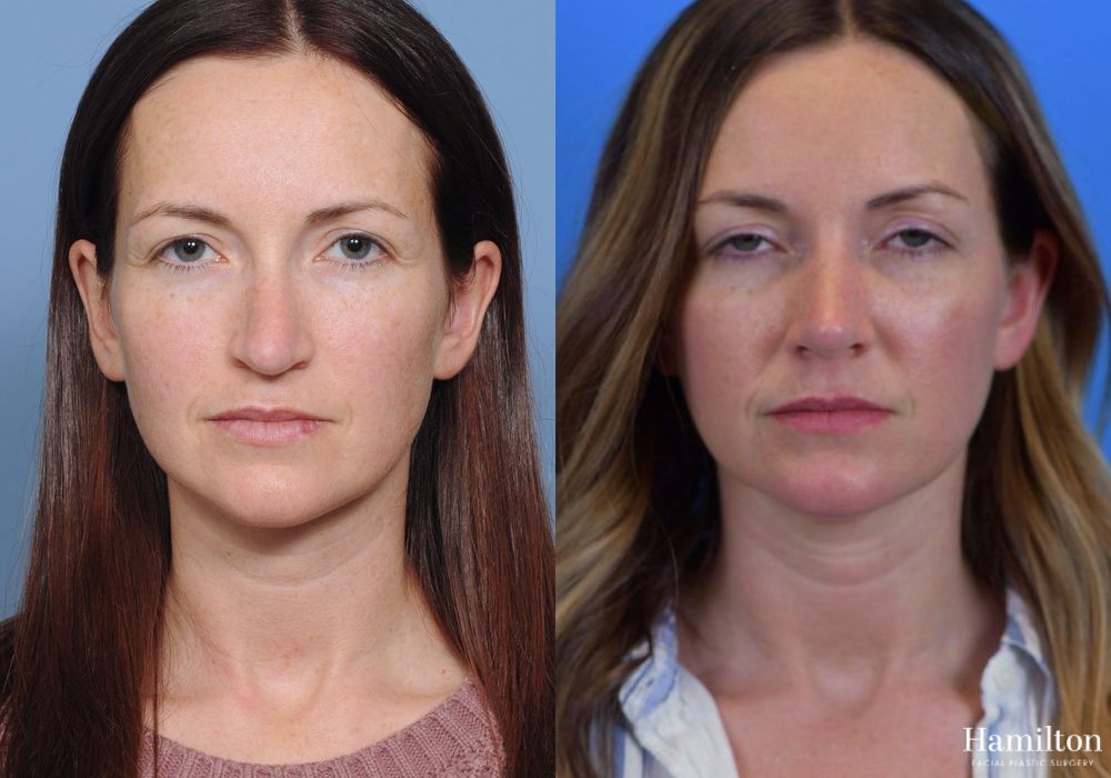 Before and after Rhinoplasty case 37199 - Angle 3