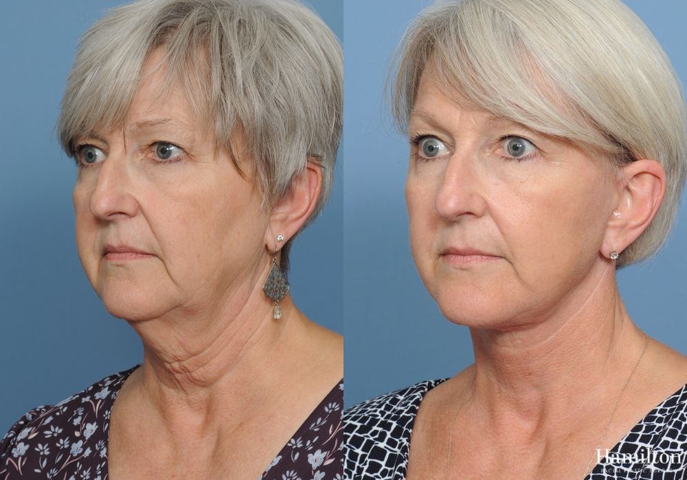 Before and after Neck Rejuvenation case 37127 - Angle 3