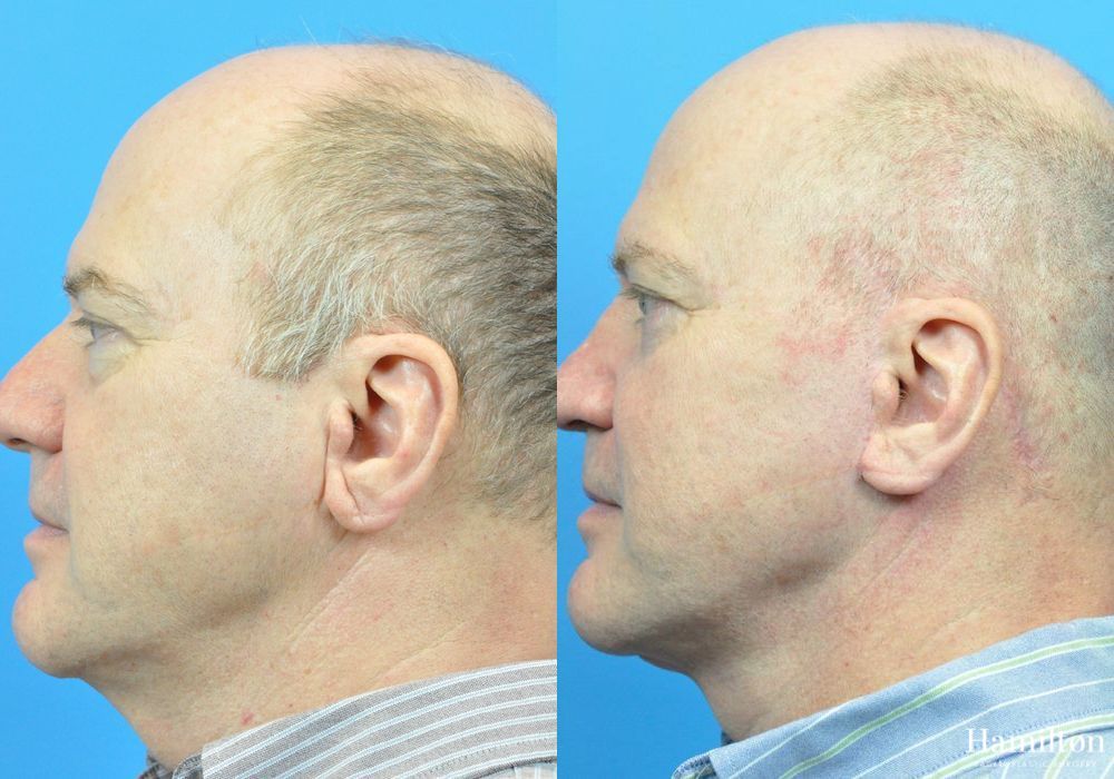 Before and after Facelift case 37306 - Angle 3