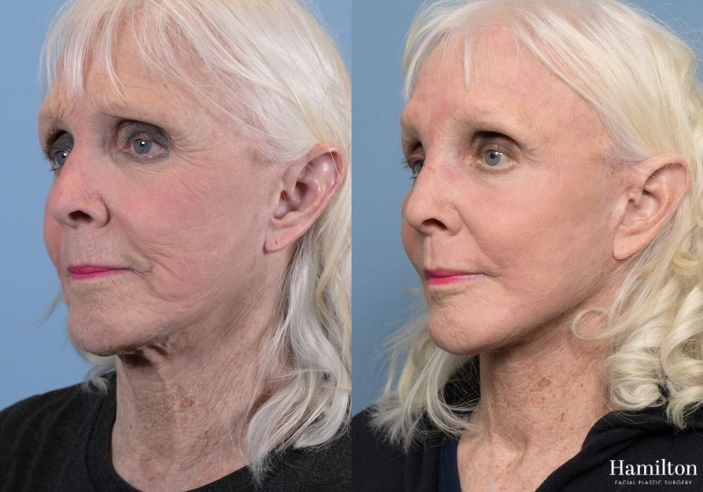 Before and after Facelift case 37281