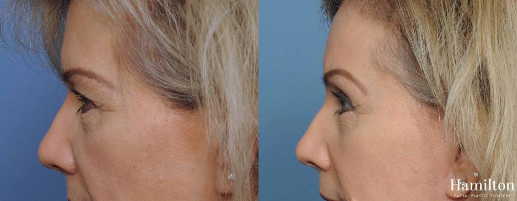 Before and after Blepharoplasty case 37253 - Angle 4