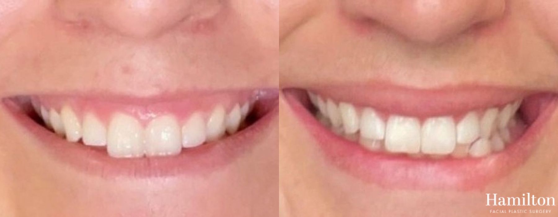 Before and after Lip Enhancement case 37120